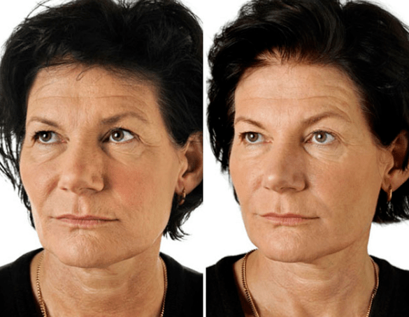 Sejas frakcionētās atjaunošanās rezultāts