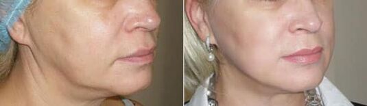 Foto pēc procedūras piemērošanas