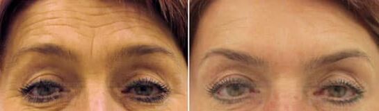 Lauka pieres atjaunošanās